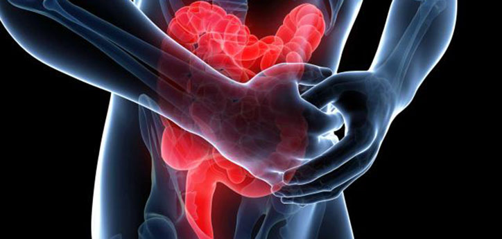 Ucerative colitis treatment, ulcer, ulcer treatment