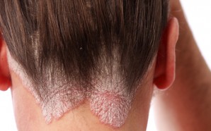 Plaque Psoriasis Treatement