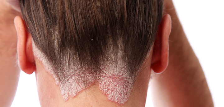 scalp plaque psoriasis, scalp plaque psoriasis treatment, scalp psoriasis treatment