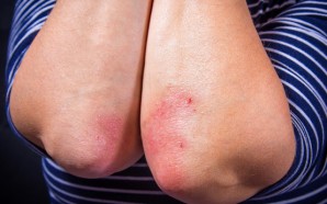 All About Psoriasis: From Plaque Psoriasis Treatments to Pustular