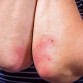 plaque psoriasis treatments, psoriasis treatment, psoriasis treatment option