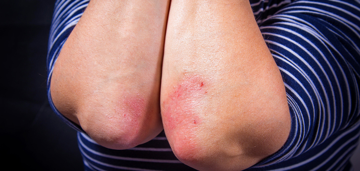 plaque psoriasis treatments, psoriasis treatment, psoriasis treatment option