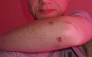 Shingles Pain Relief