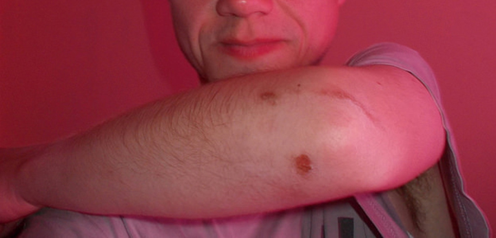 shingles nerve pain, shingles pain treatment, shingles, shingles treatment
