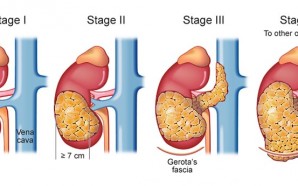 renal cell carcinoma cancer, metastatic renal cell carcinoma, kidney cancer