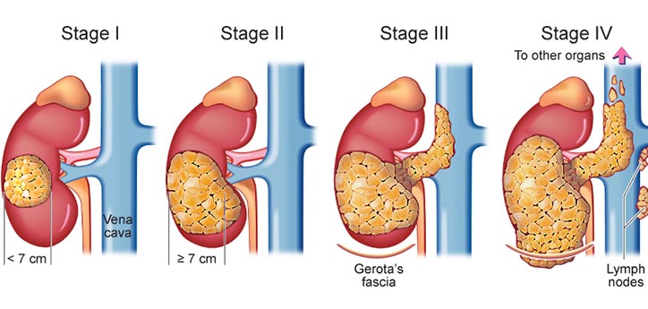renal cell carcinoma cancer, metastatic renal cell carcinoma, kidney cancer