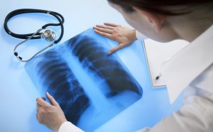 rheumatoid arthritis pulmonary fibrosis