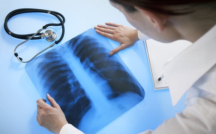 rheumatoid arthritis pulmonary fibrosis