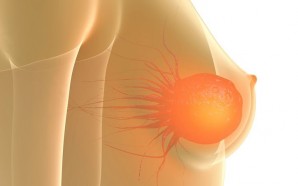 metastatic breast cancer treatments