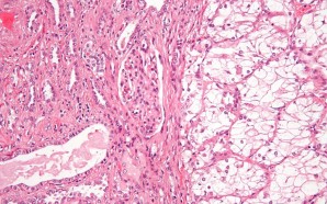 Signs and Symptoms of Renal Cell Carcinoma