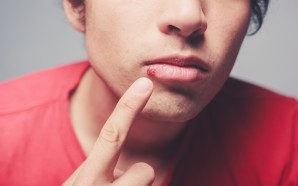 Top 6 Cold Sores Treatments