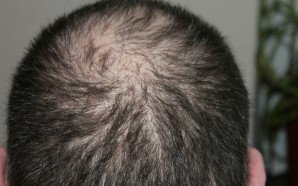 What Causes Hair Loss?