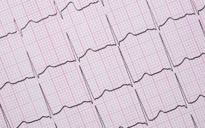 Myocardial Infarction