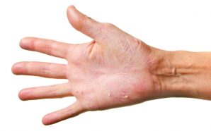 chronic eczema treatment