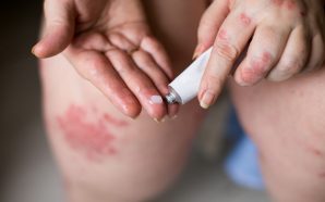 eczema ointment
