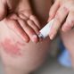 eczema ointment