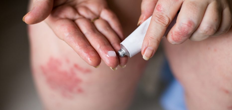 eczema ointment