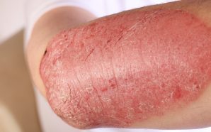 cosentyx plaque psoriasis treatment