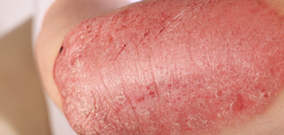 cosentyx plaque psoriasis treatment