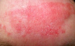 dupixent dupilumab eczema treatments