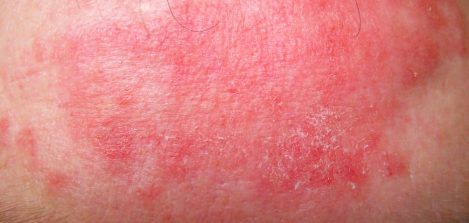 dupixent dupilumab eczema treatments