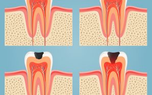 Tooth Abscess Treatment