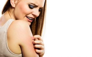 severe eczema treatment