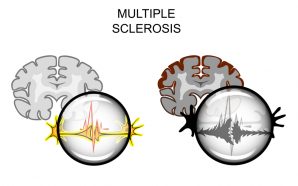 copaxone multiple sclerosis treatments