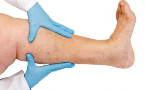 deep vein thrombosis medications