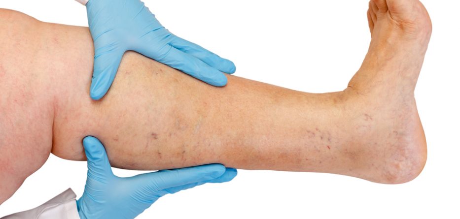 deep vein thrombosis medications