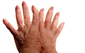 rheumatoid arthritis fibromyalgia treatments