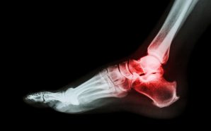 treatment for rheumatoid arthritis ankle pain