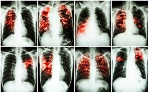 pulmonary fibrosis management