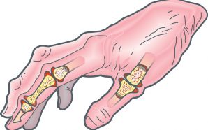 rheumatoid arthritis finger pain treatment