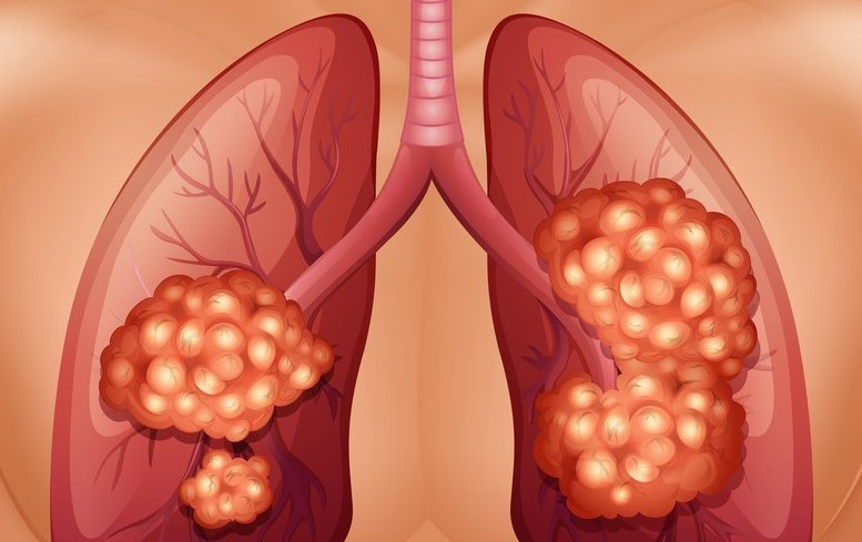Gemcitabine NSCLC Lung Cancer Treatments